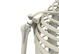 Reverse Shoulder Replacement