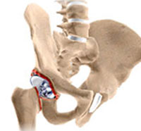 Revision Hip Replacement