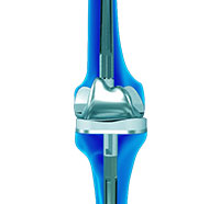 Revision Knee Replacement