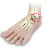 Rheumatoid Arthritis of the Foot and Ankle