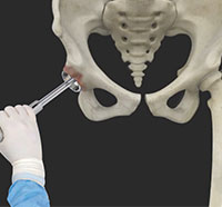 Robotic-assisted Hip Surgery