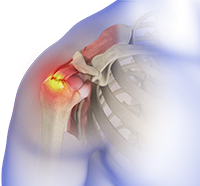 Rotator Cuff Tear