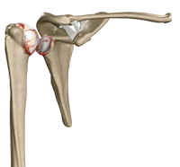 Shoulder Arthritis