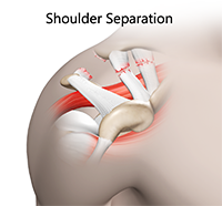 Shoulder Separation