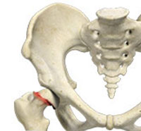 Slipped Capital Femoral Epiphysis