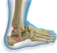 Talus Fractures