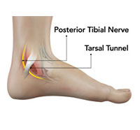 Tarsal Tunnel Syndrome