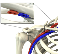 Thoracic Outlet Syndrome