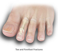 Toe and Forefoot Fractures