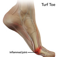 Turf Toe