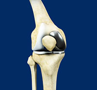 Unicondylar (Unicompartmental) Knee Replacement