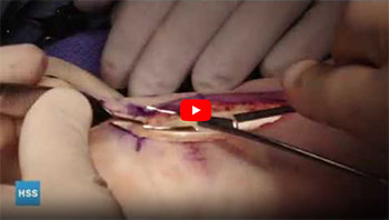 Surgical Video Anafab Repair