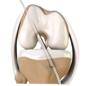 Picture of ACL Reconstruction