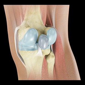 Picture of Baker’s Cyst