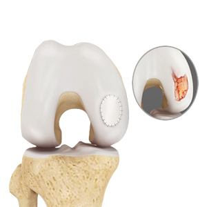 Picture of Cartilage Repair and Transplantation