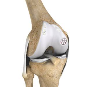 Picture of Cartilage Replacement