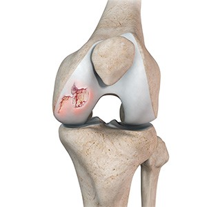 Picture of Chondral (Articular Cartilage Defects)