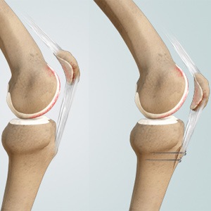 Picture of Distal Realignment Procedures