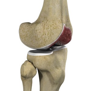 Picture of Knee Arthritis