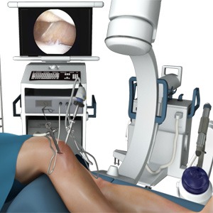 Picture of Knee Arthroscopy