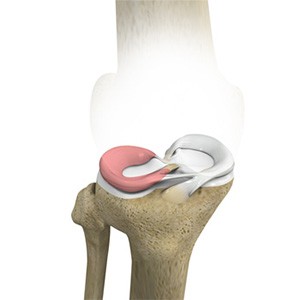 Picture of Lateral Meniscus Syndrome