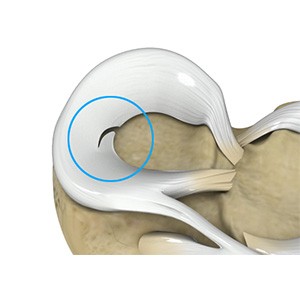 Picture of Meniscal Tears
