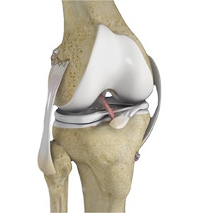 Picture of Multi Ligament Reconstruction