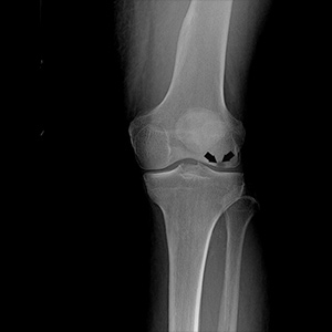 Picture of Osteonecrosis of the Knee