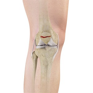 Picture of Patella Fracture
