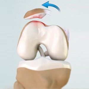 Picture of Patellar Dislocation / Patellofemoral Dislocation