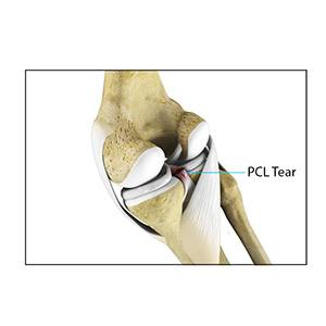 Picture of PCL Injuries