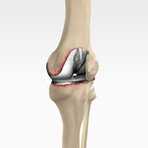 Picture of Revision Knee Replacement