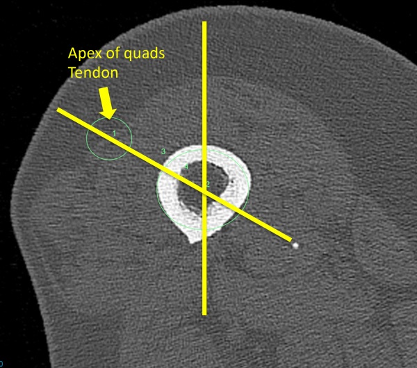 Picture of Measure Quadriceps Alignment