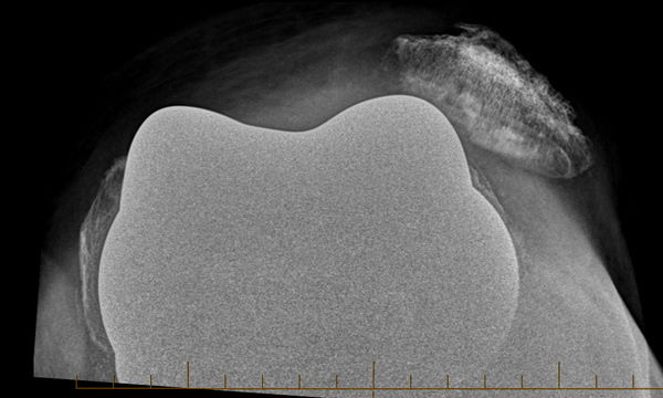 Picture of Quadriceps Malalignment Is Associated With Worse Outcomes
