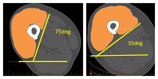 Picture of Quadriceps Muscle Malalignment Is Due to a Deformity in the Muscle