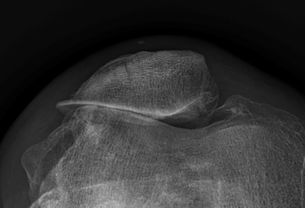 Picture of Looked Closely at Quadriceps Alignment