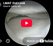 2nd look after lateral dovetail meniscus transplant