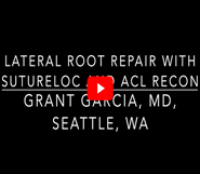 ACL Recon with Lateral Root Repair with Sutureloc
