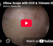 Dr. Garcia’s latest technique for elbow arthroscopy and OCD treatment