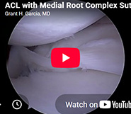 Rare meniscal root pattern with repair.