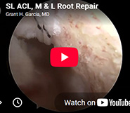 Fertilized ACL with Complex Double Sutureloc Meniscal Root Repair