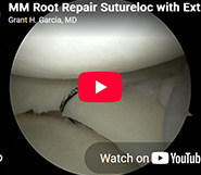 Updated Meniscal Root Repair with Centralization Stitch