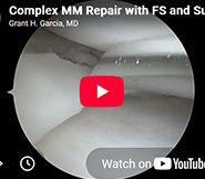 Complex Meniscus Repair: Using multiple techniques