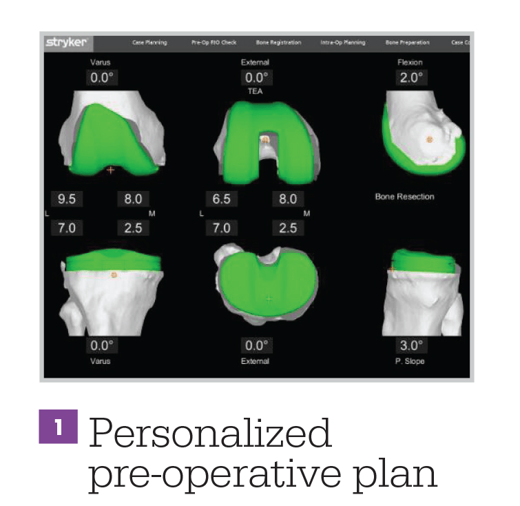 MAKO (Robotic Assisted) Total knee replacement