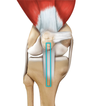 ACL Reconstruction Patellar Tendon