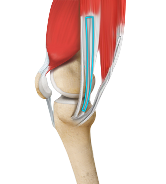 ACL Reconstruction Procedure – Hamstring Tendon