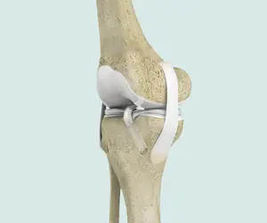 ACL Reconstruction