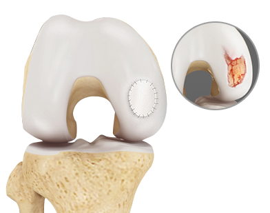 Cartilage Repair and Transplantation 