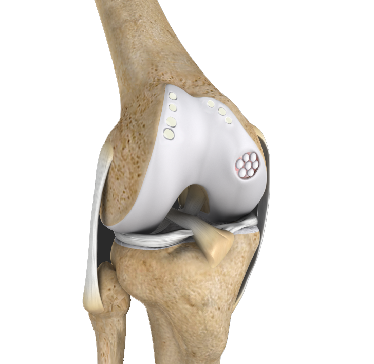 Cartilage Replacement 