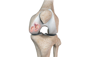 Chondral (Articular Cartilage Defects)